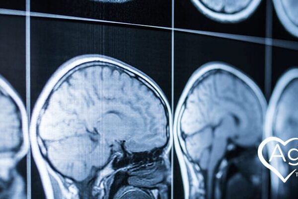 MRI brain scans in black and white next to Agape Treatment Center logo in white with heart shape.