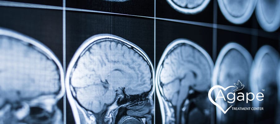 MRI brain scans in black and white next to Agape Treatment Center logo in white with heart shape.